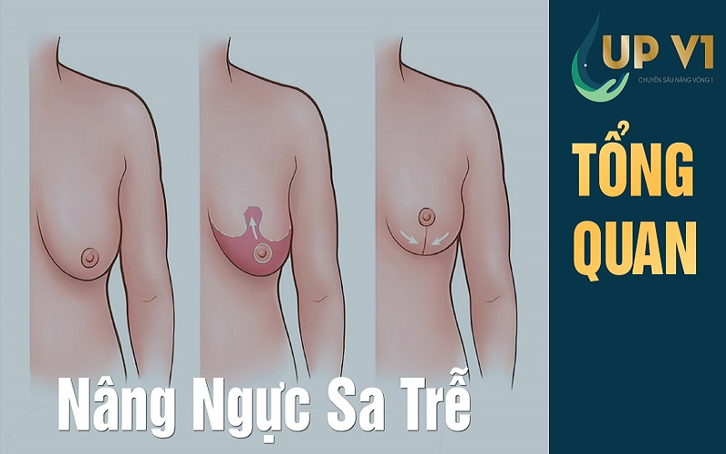 Tổng quan phẫu thuật ngực sa trễ