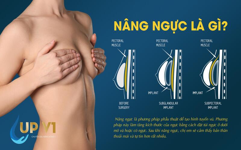 nâng ngực 