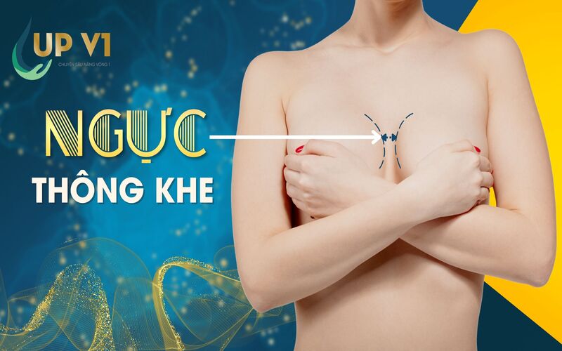 bị thông khe sau nâng ngực