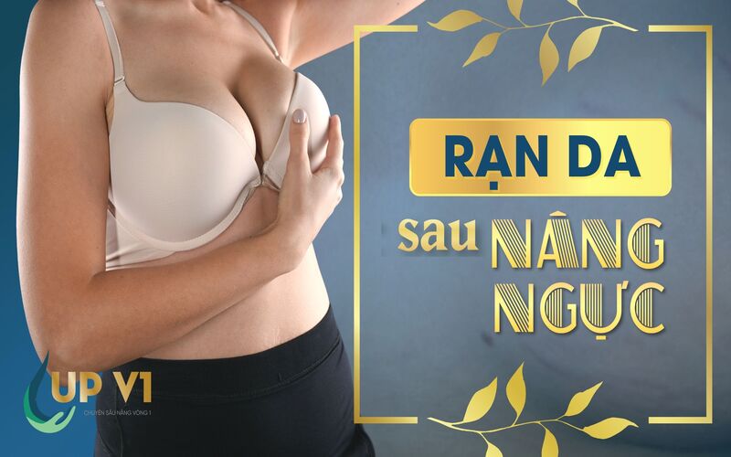 nâng ngực bị rạn da