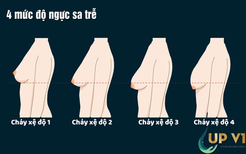 4 mức độ ngực sa trễ