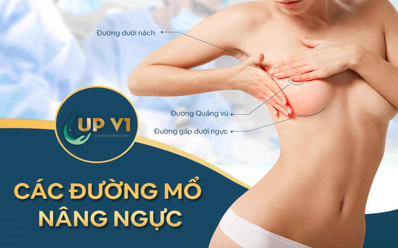 Các đường mổ nâng ngực