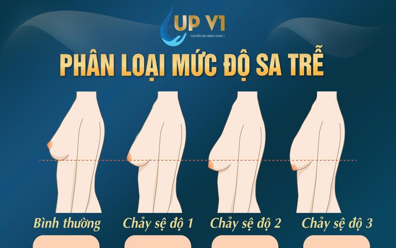 Các mức độ sa trễ ngực