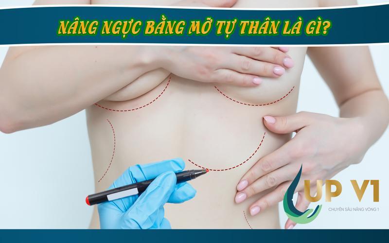 Nâng ngực bằng mỡ tự thân là gì