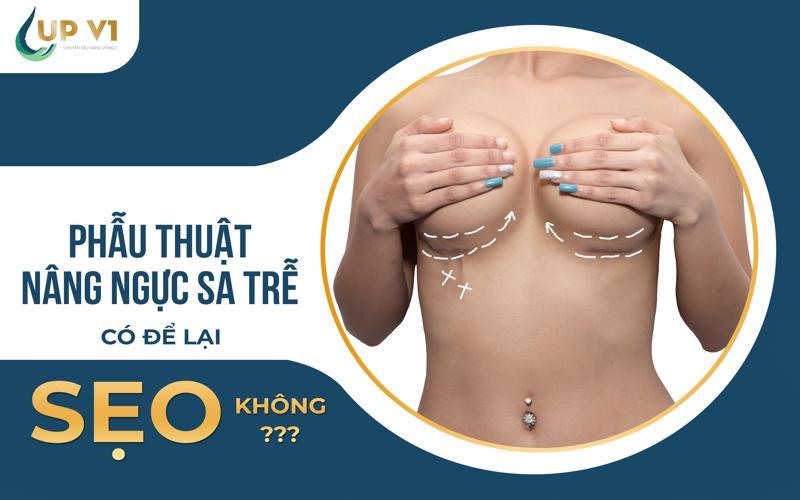 treo ngực sa trễ có để lại sẹo không