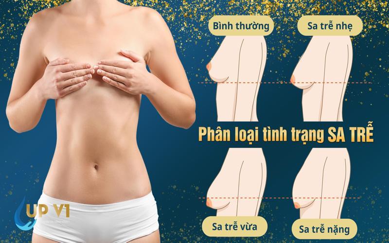 phân loại ngực sa trễ