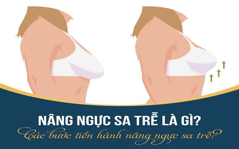 Nâng ngực sa trễ là gì