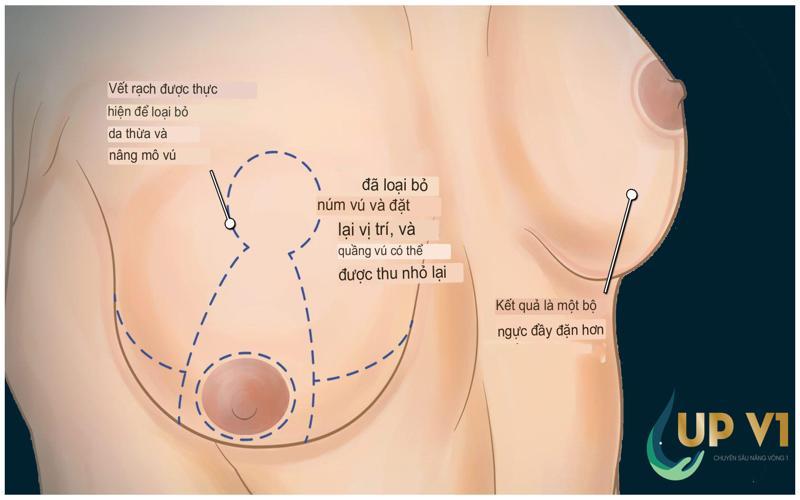 quá trình nâng ngực sa trễ cắt tuyến là gì