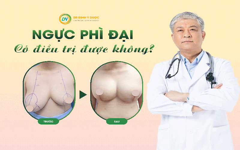 Ngực phì đại có điều trị được không