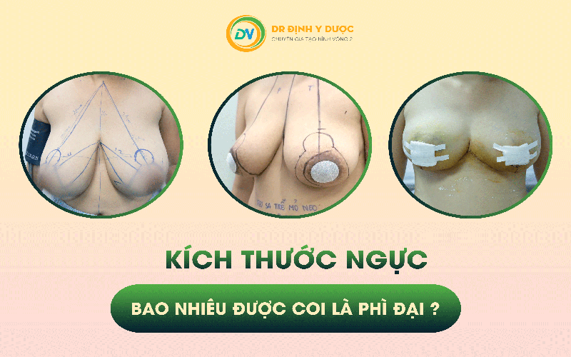 kích thước ngực phì đại