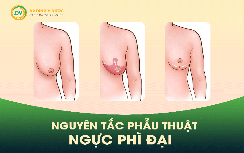 Nguyên tắc phẫu thuật ngực phì đại