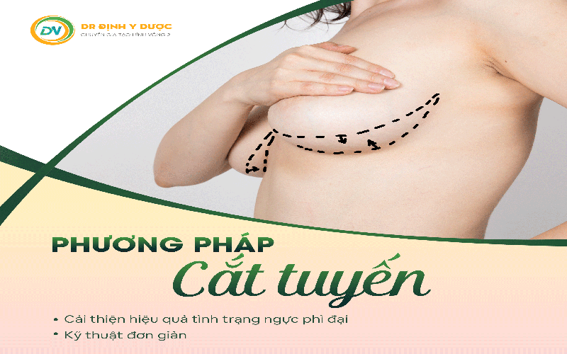 phương pháp phẫu thuật ngực phì đại cắt tuyến