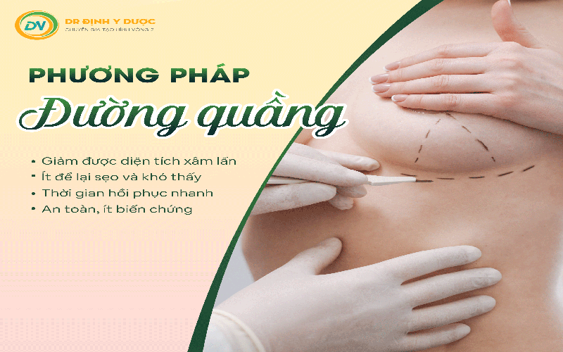 phương pháp nâng ngực đường quầng