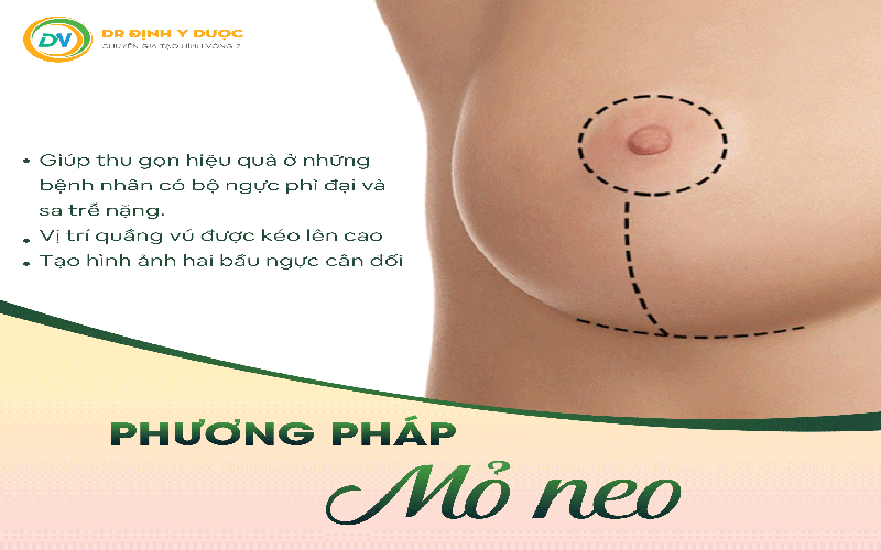 phương pháp nâng ngực mỏ neo