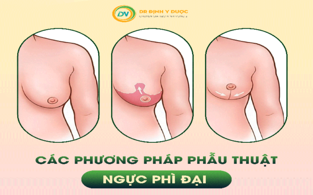 Các phương pháp phẫu thuật ngực phì đại