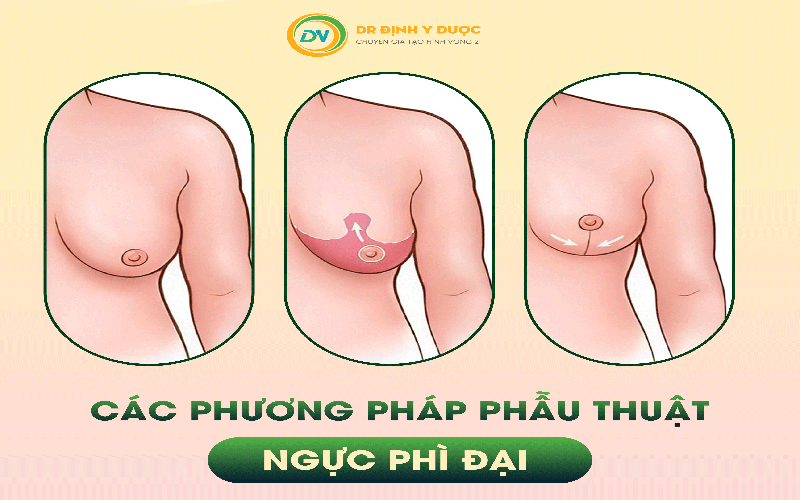 Các phương pháp phẫu thuật ngực phì đại