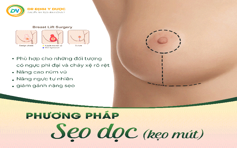 phương pháp phẫu thuật ngực phì đại sẹo dọc