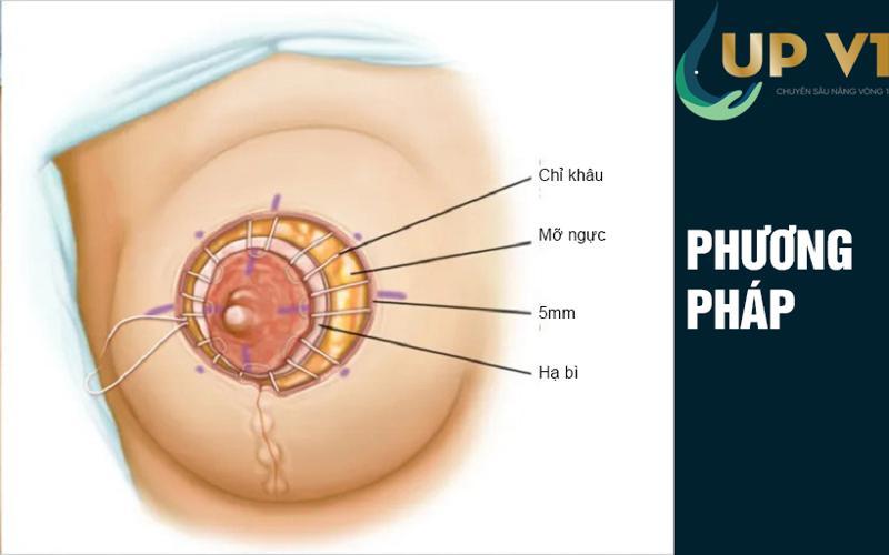 phương pháp nâng ngực sa trễ sẹo dọc