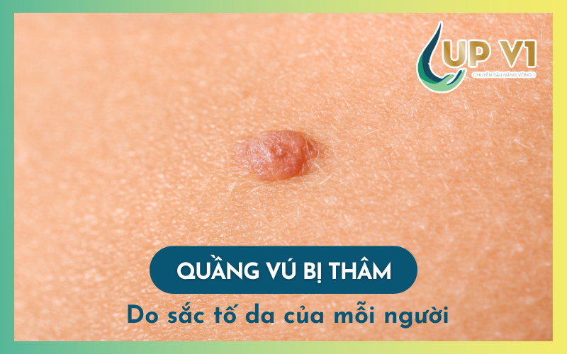 quầng vú thâm do sắc tố da