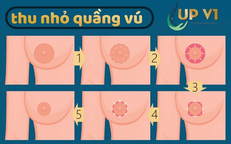 thu gọn quầng vú