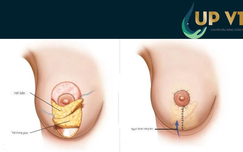 ưu điểm nâng ngực sa trễ sẹo dọc