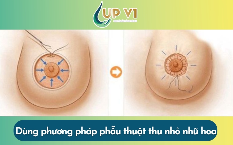 phẫu thuật thu nhỏ nhũ hoa