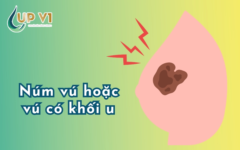 vú có khối u