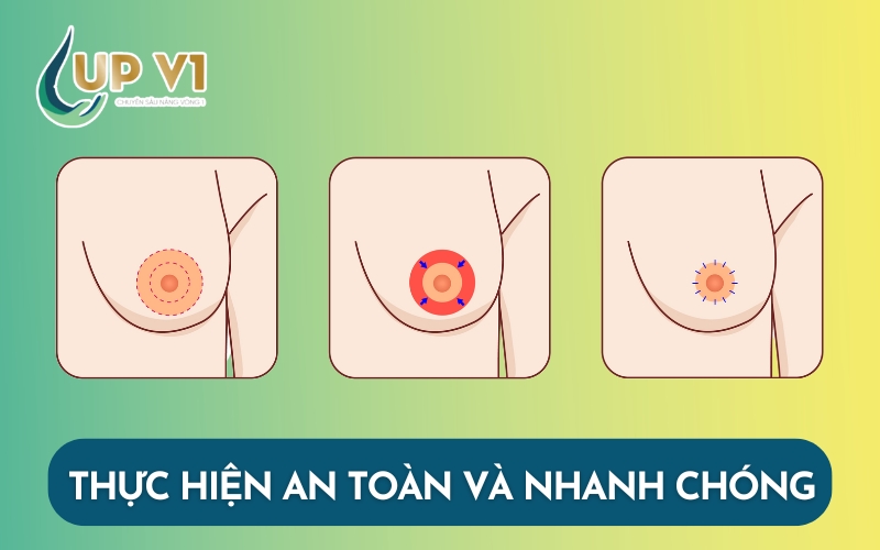 thu nhỏ đầu vú an toàn