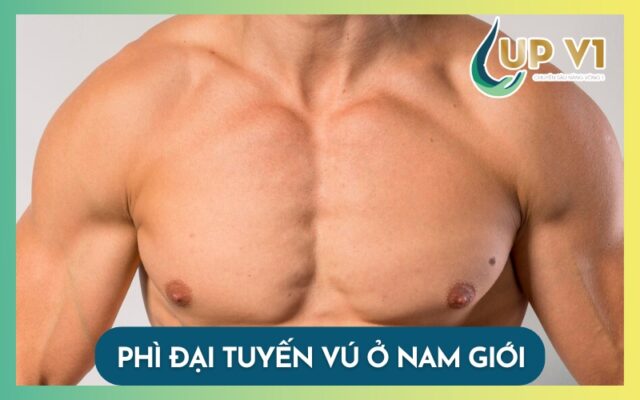 phì đại tuyến vú ở nam giới