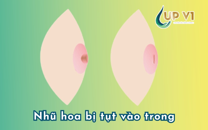 nhũ hoa bị tụt vào trong