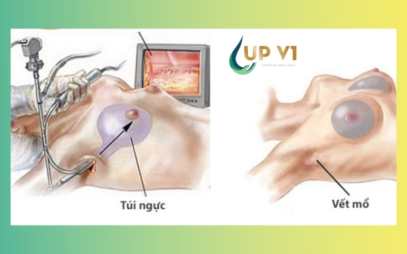 quá trình nâng ngực nội soi